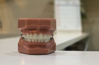 Nevidni zobni aparat – invisalign
